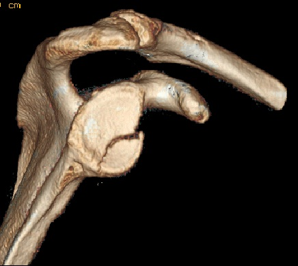 كسور لوح الكتف: الأسباب والتشخيص والعلاج