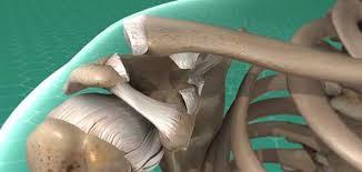 تجبير عظمة الترقوة عند الكبار