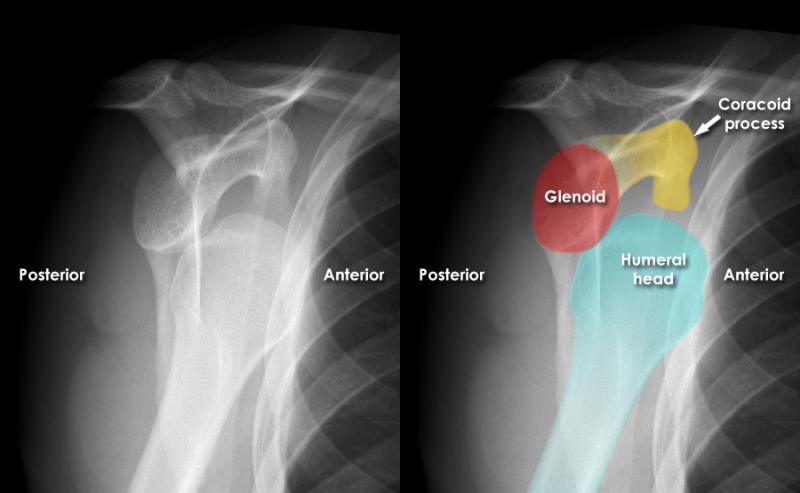 اِفْحَص كتفك المخلوع: دليلك المذهل لامتحان العظام!