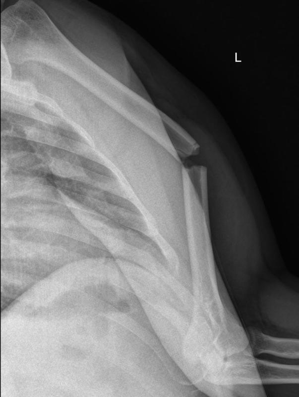 اكتشف: تشخيص وعلاج كسور عظم العضد | دليل طبي شامل