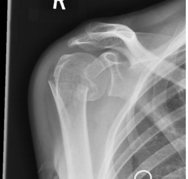 دليلك الشامل: علاج كسور عظم العضد القريبة | طب العظام