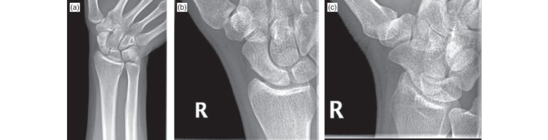 دليلك الشامل لـ كسور العظم الزورقي: علاج ومضاعفات