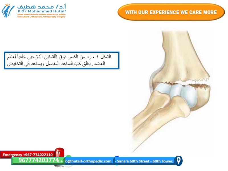 الرد المغلق والتثبيت عن طريق الجلد لكسور فوق اللقمتين في عظم العضد تشخيص متباين 