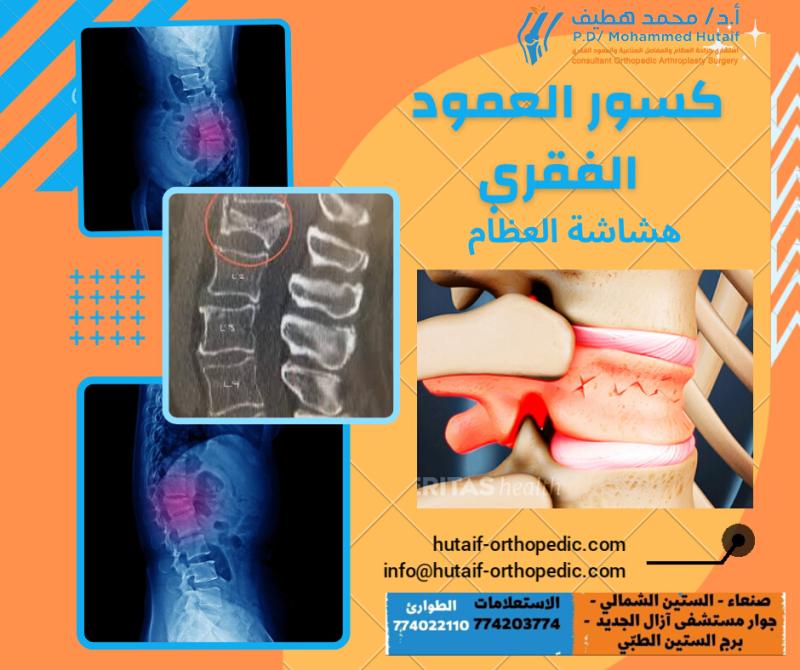 هشاشة العظام وكسور العمود الفقري