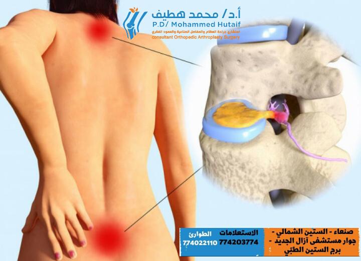 How Serious is a Prolapsed Disc? Avoid Permanent Nerve Damage