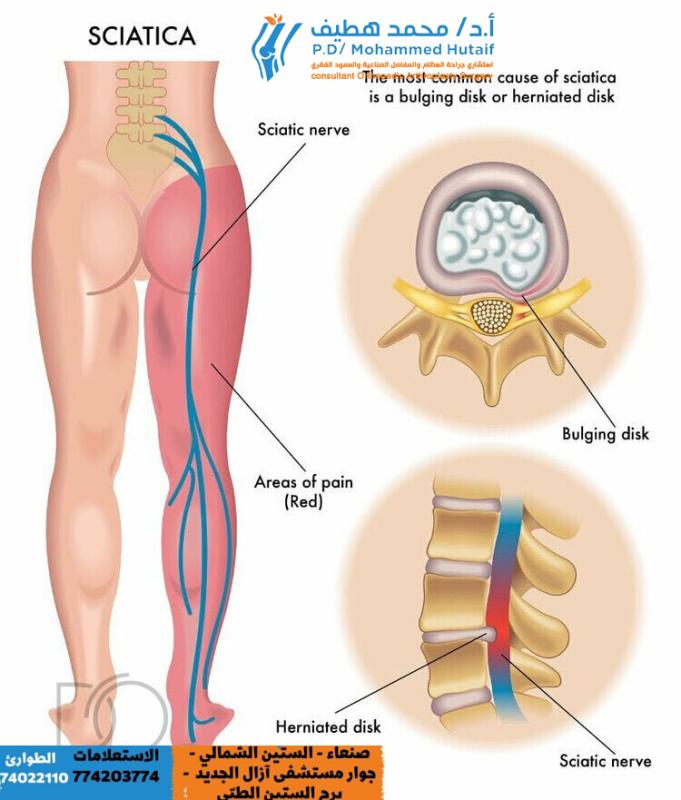 The Best Treatment for Disc Prolapse: Non-Surgical Solutions