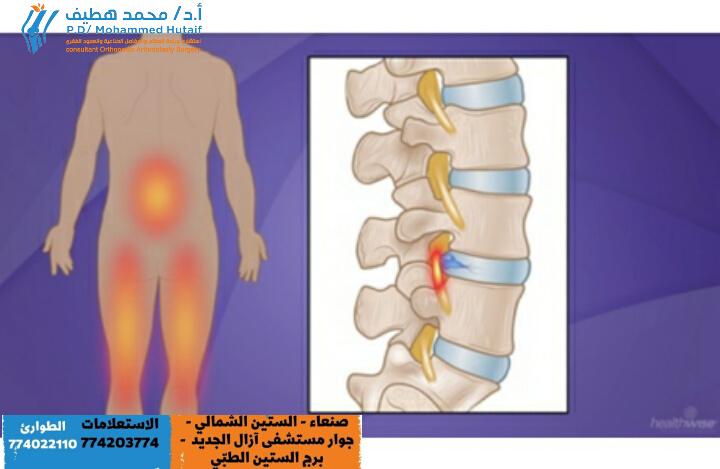 Heal Your Prolapse Disc Without Surgery: It's Possible!