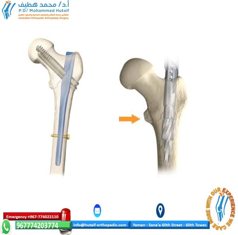 Cephalomedullary Nailing of the Proximal Femur Fractures