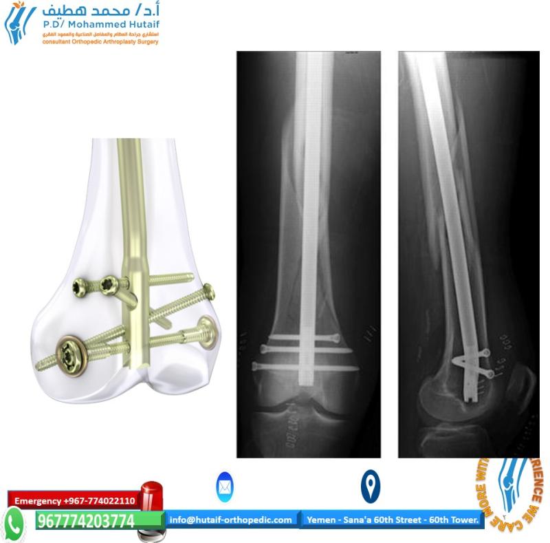 Retrograde Intramedullary Nailing of the Femur FRACTUREs