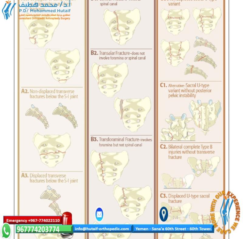 AO sacral fracture classification