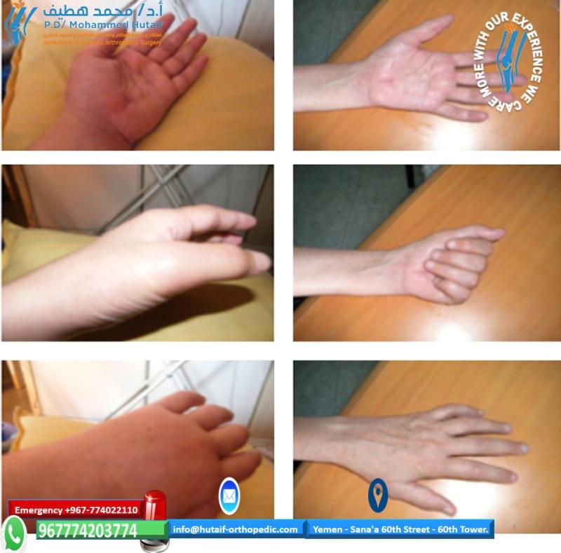 Complex Regional Pain Syndrome