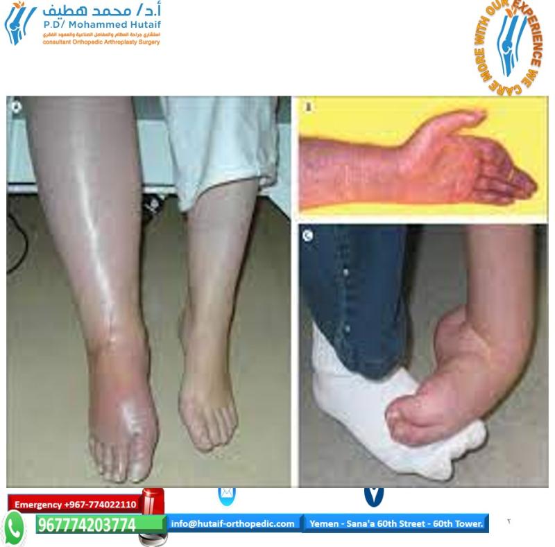 Complex Regional Pain Syndrome