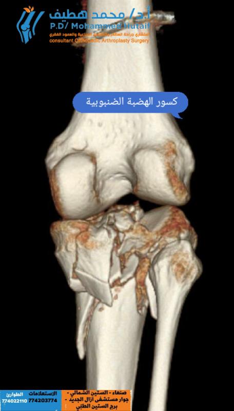 كسور الهضبة الضنبوبية 