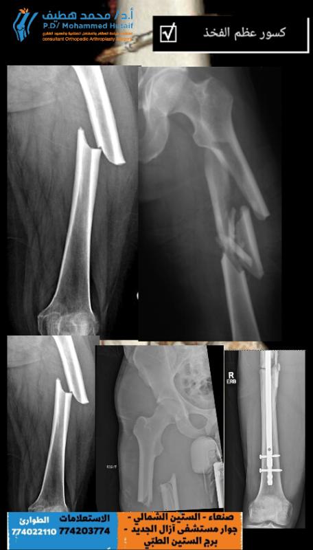 كسور عظم الفخذ