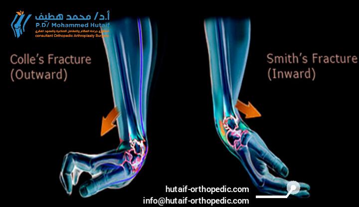 Smith vs Colles Fracture