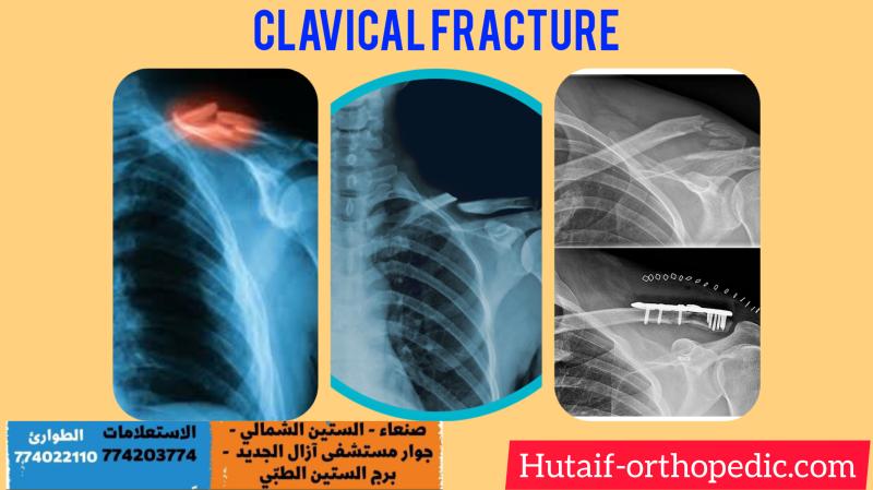 Clavicle Fractures: Epidemiology, Surgical Anatomy, Biomechanics & Classification