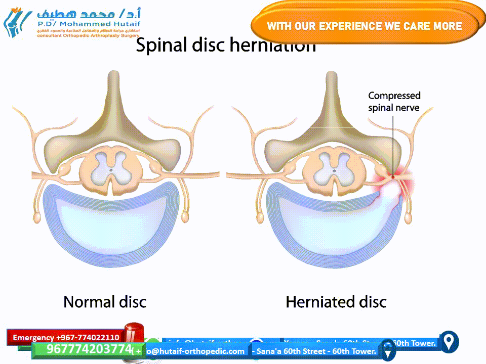 Herniated Disc Relief: Expert Videos & Surgeons in Yemen - httpshutaiforthocom