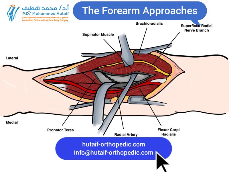 The Forearm Approaches