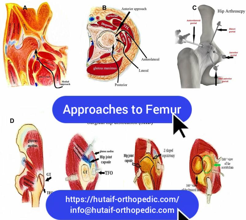 Approaches to Femur