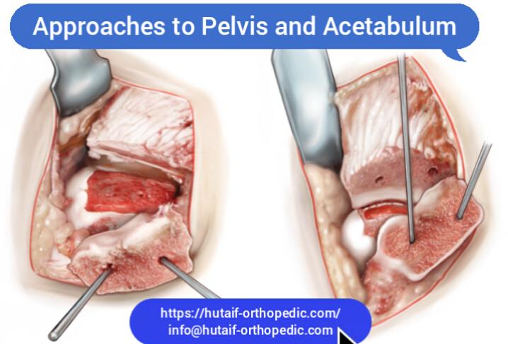 Approaches to Pelvis and Acetabulum