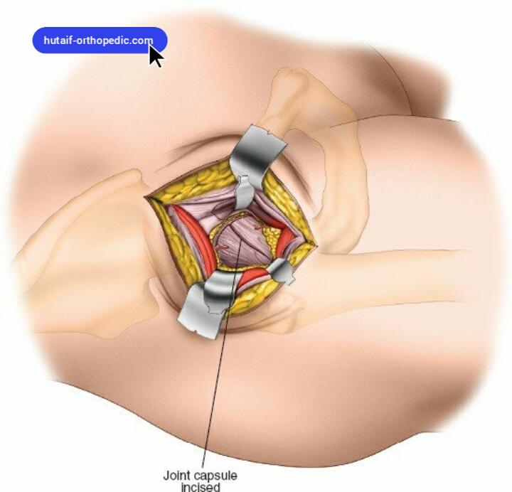 Minimally Invasive Anterior Approach to the Hip