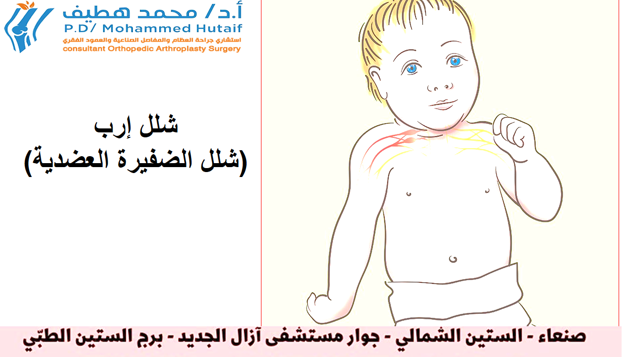 شلل إرب (شلل الضفيرة العضدية)
