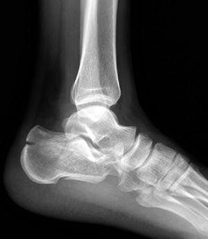 كسر عظم الكعب: الأعراض، التشخيص، والعلاج لاستعادة حركتك بلا ألم