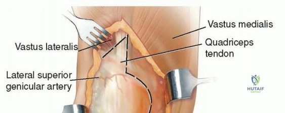 بسط العضلة الرباعية بتقنية V-Y: حلول الأستاذ الدكتور محمد هطيف لتعقيدات جراحة الركبة