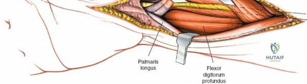Illustration of tunnel and wrist - Dr. Mohammed Hutaif