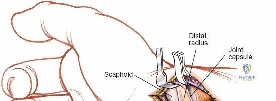 Comprehensive Guide to Scaphoid Volar Approach: Anatomy, Indications & Surgical Technique