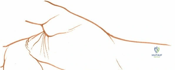 Illustration of approach to the ulnar - Dr. Mohammed Hutaif